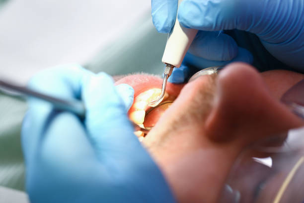 Best Emergency Root Canal Treatment in Moss Point, MS